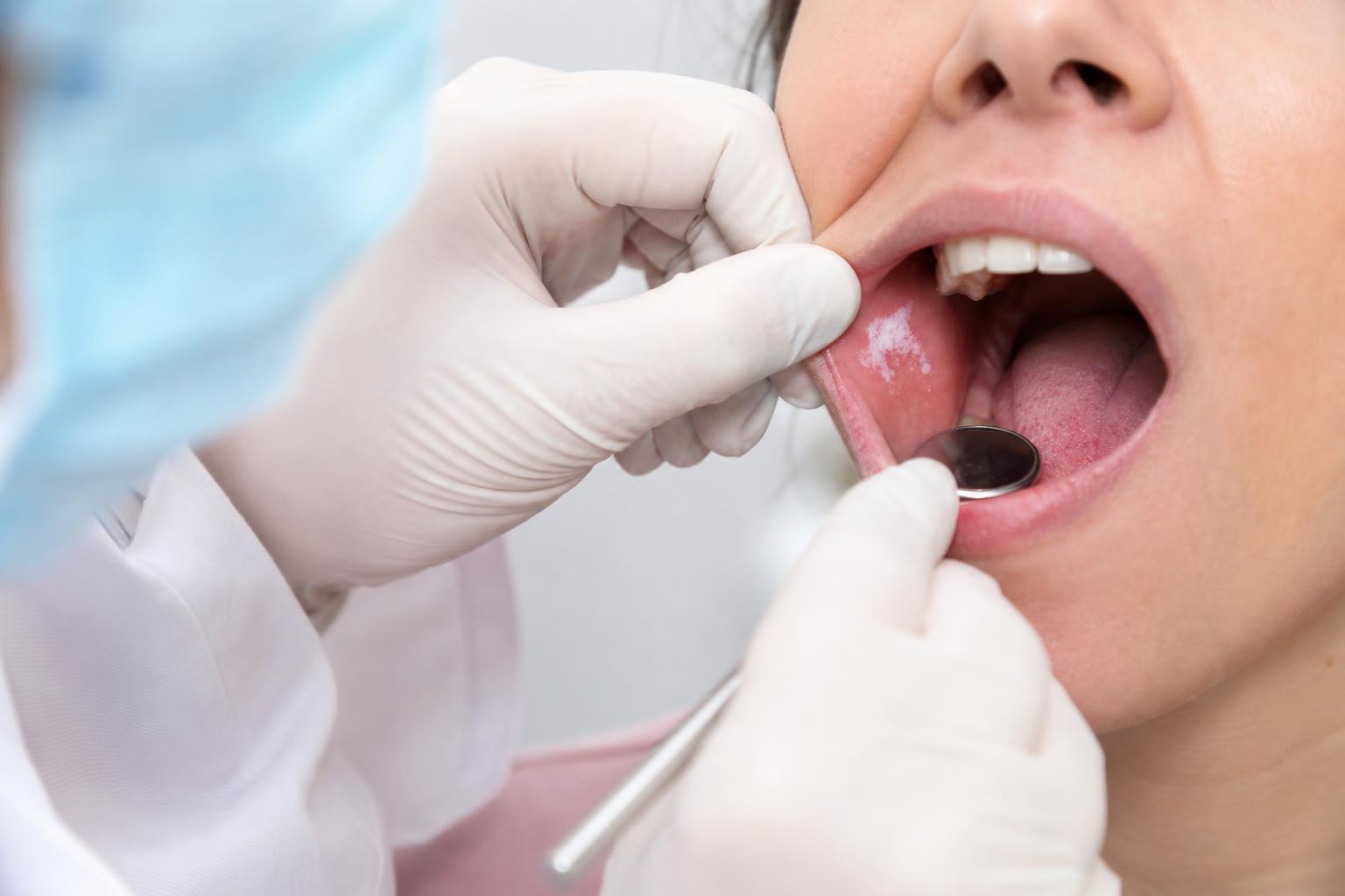 Leucoplasia Oral: Mancha Branca na Boca É Grave?