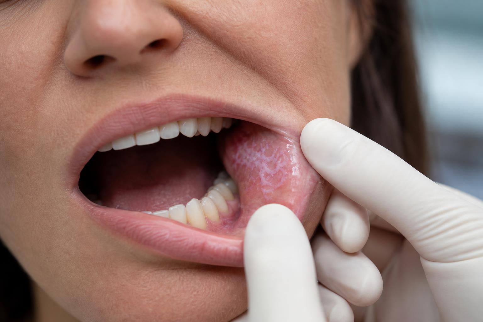 Líquen Plano Oral: manchas brancas que não somem?