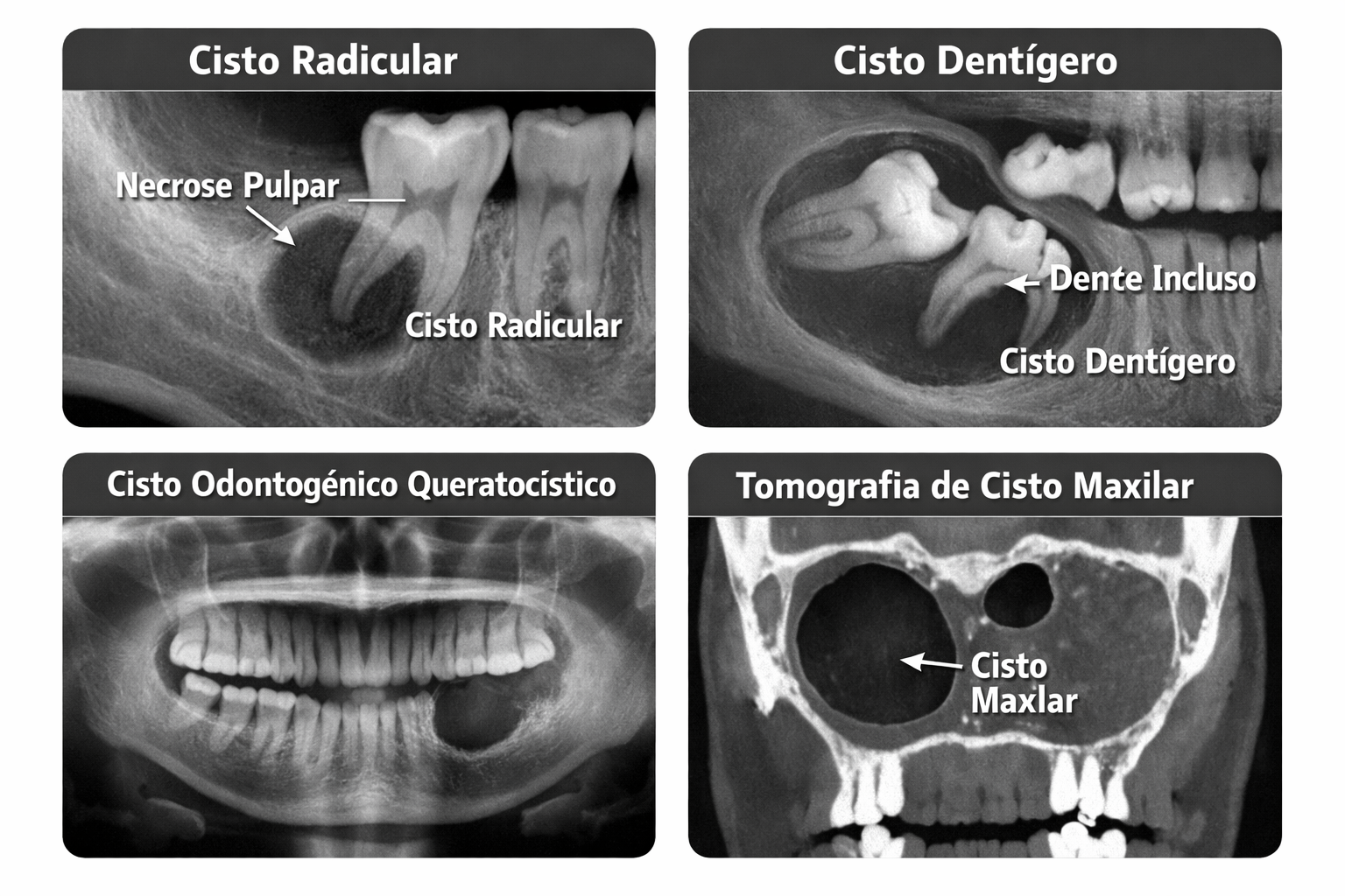 Cistos dos Maxilares: Tipos, Diagnóstico e Tratamento Especializado