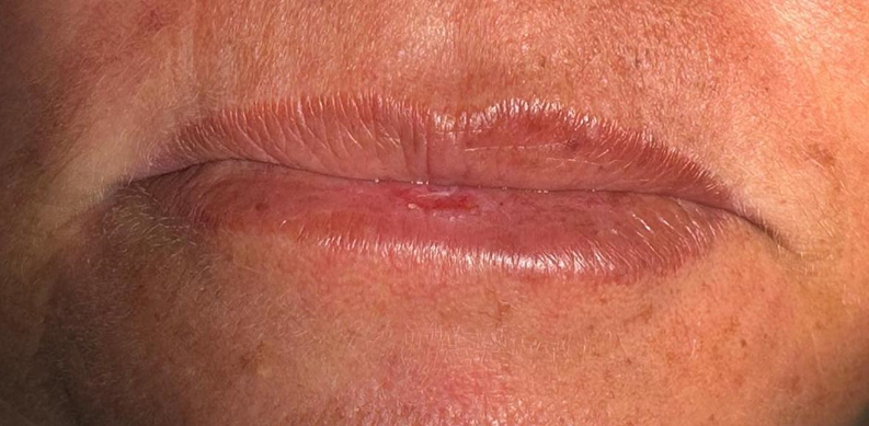 Queilite Actínica: causas, diagnóstico, tratamento e prevenção